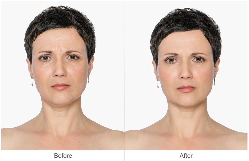 Botox CMEA